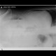 Carcinoma of transverse colon, ileus, perforation of bowel, peritonitis: X-ray - Plain radiograph
